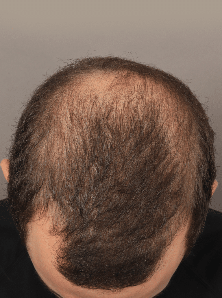 Before Image: Male NeoGraft (9 Months Post-op) - front