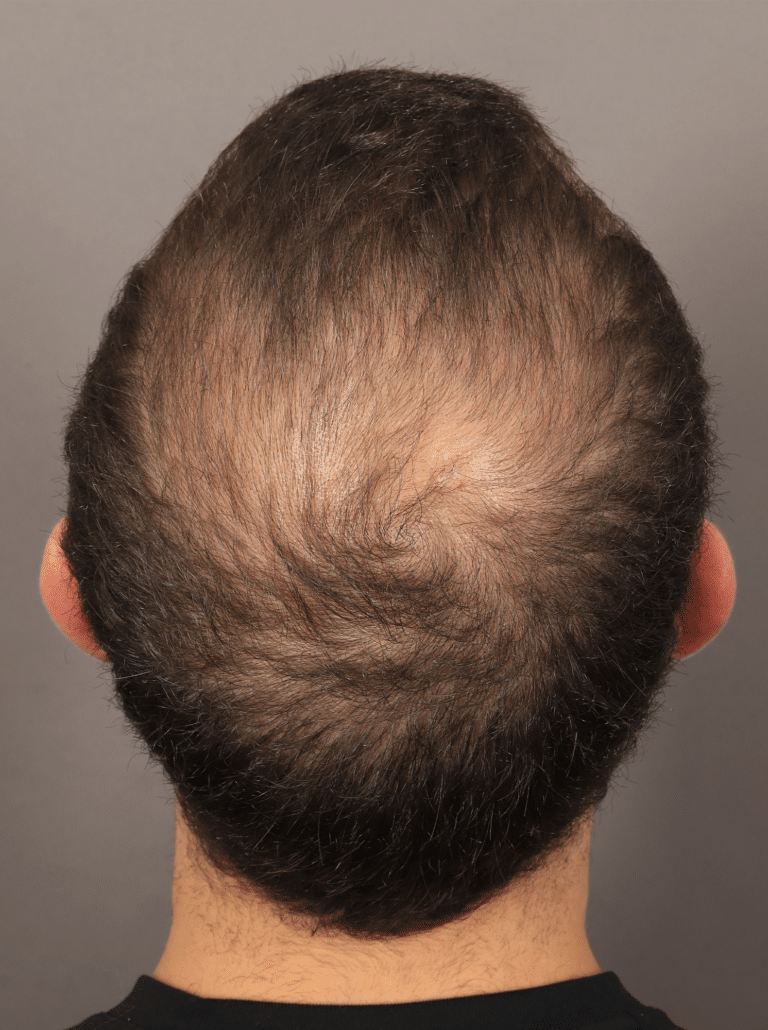 Before Image: Male NeoGraft (9 Months Post-op) - back
