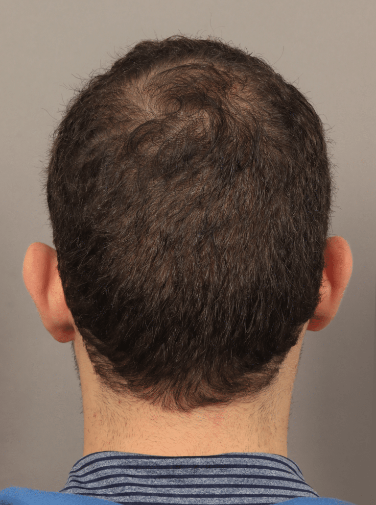 After Image: Male NeoGraft (9 Months Post-op) - back