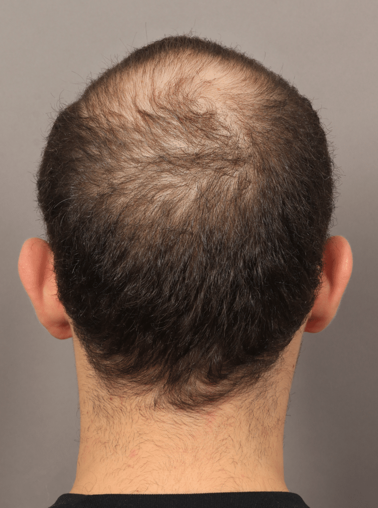 Before Image: Male NeoGraft (9 Months Post-op) - back