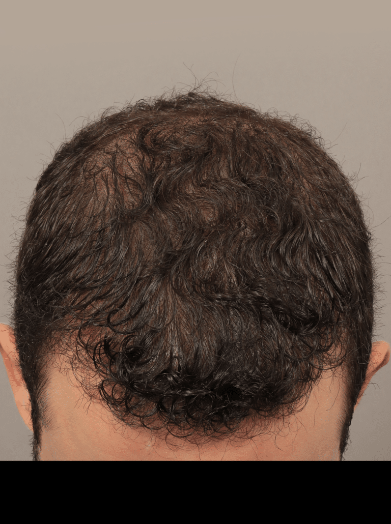 After Image: Male NeoGraft (9 Months Post-op) - front