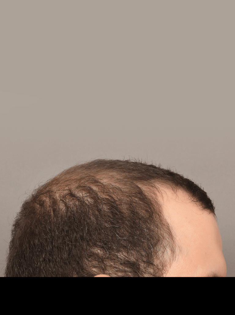 Before Image: Male NeoGraft (9 Months Post-op) - right-side