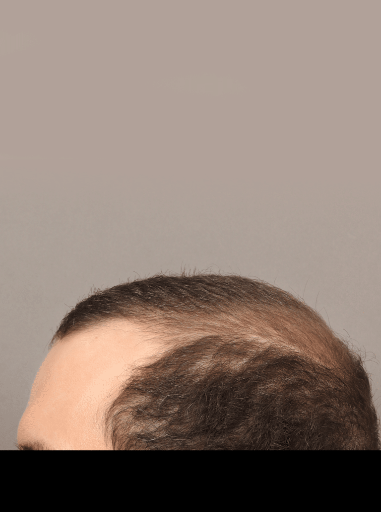 Before Image: Male NeoGraft (9 Months Post-op) -