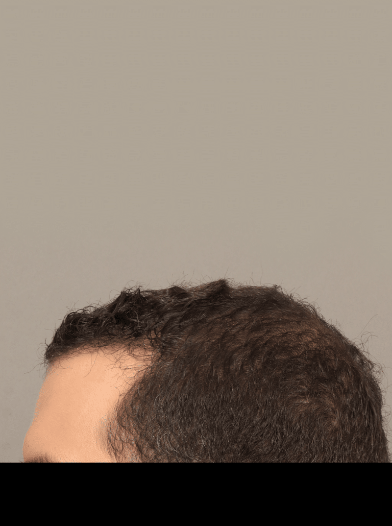 After Image: Male NeoGraft (9 Months Post-op) -