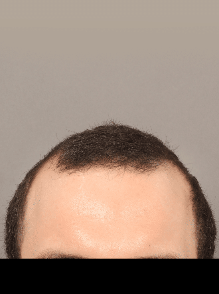 Before Image: Male NeoGraft (9 Months Post-op) - front